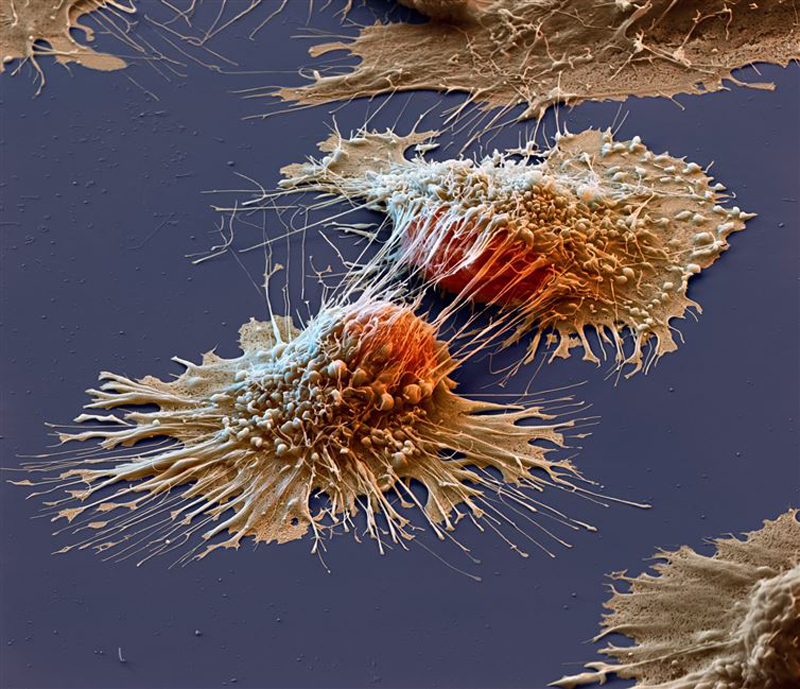 Cancer-cells-under-an-electron-microscope